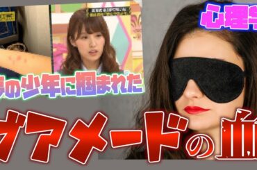 衛藤美彩の腕にアザをつけた現象は実は心理学?!