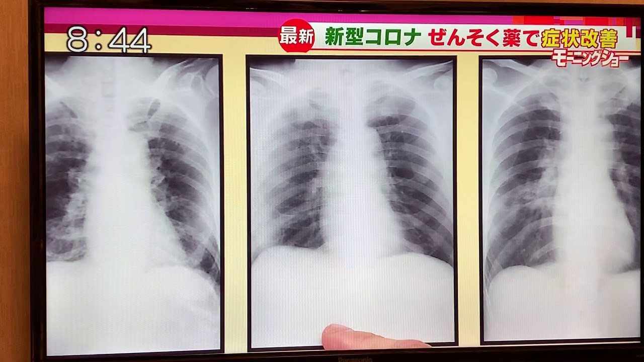 羽鳥慎一モーニングショー2020/03/04 新型コロナ 喘息薬で症状改善。