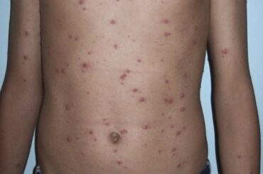 新型コロナウイルス感染症にみられる皮膚症状