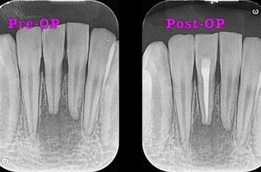 精密根管治療 　【愛知県刈谷市の歯医者】　予後観察　感染根管治療　One Visit Root Canal Therapy　オンライン診療　自由診療　顕微鏡歯科　マイクロスコープ　Kariya