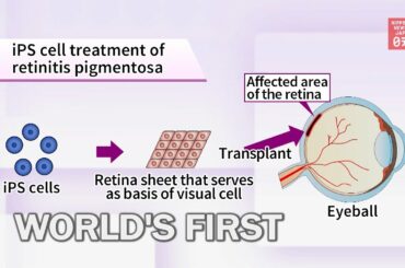 World’s first transplant of iPS derived retinal sheet in Japan