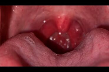【閲覧注意】コロナ感染者の喉を見せます。症状も説明します。