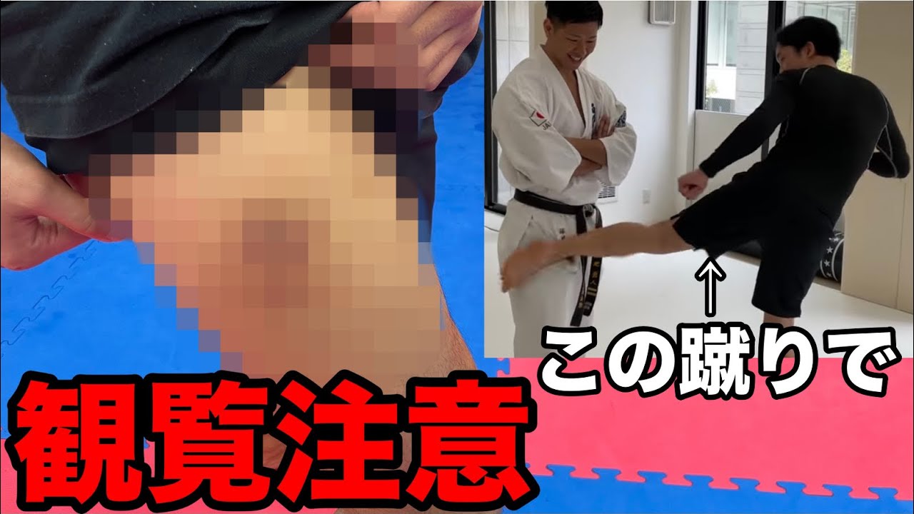 【悲報】朝倉未来選手に蹴ってもらった右足が悲惨なことに 【悲報】朝倉未来選手に蹴ってもらった右足が悲惨なことに