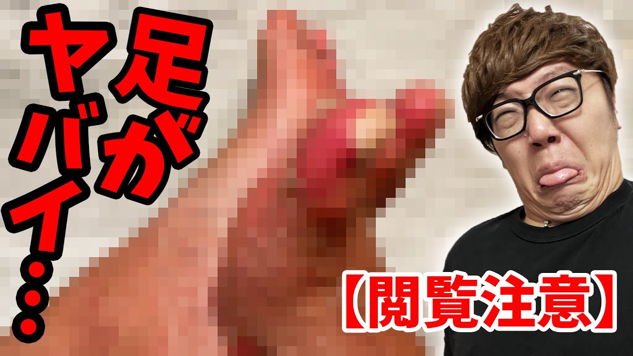 【閲覧注意】足が大変なことになってしまいました…