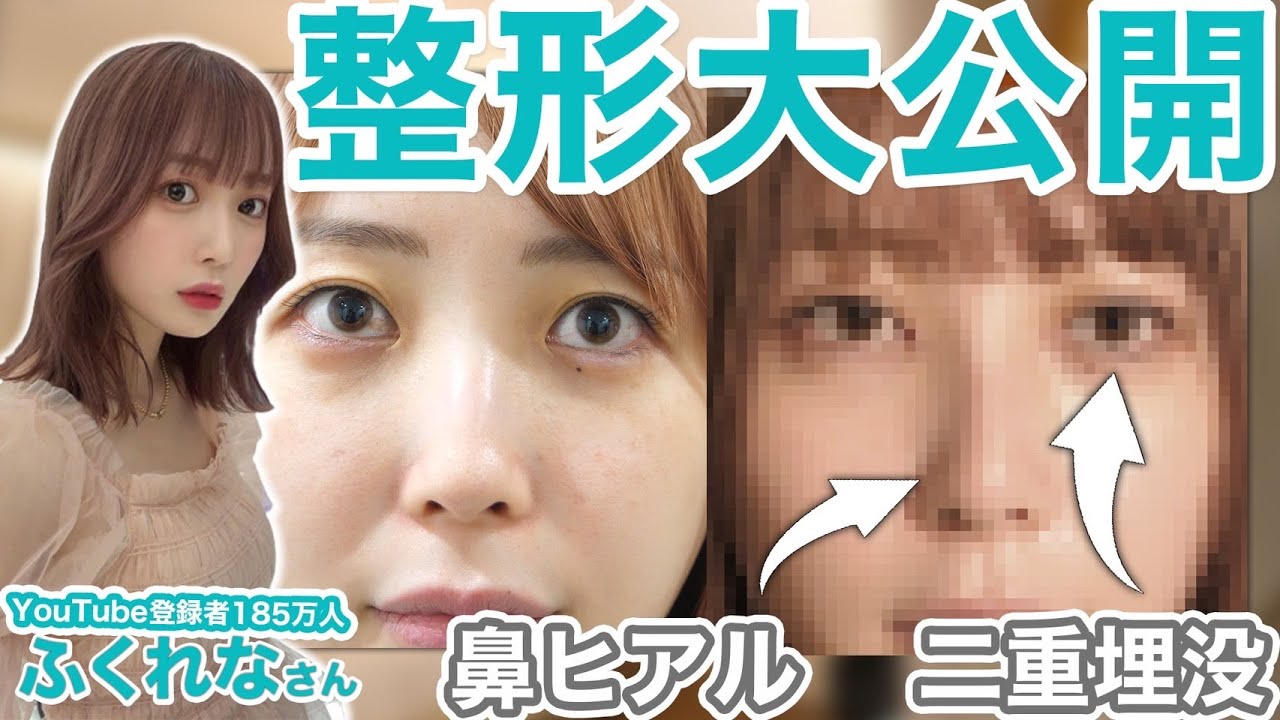 【公開】総額58万円掛かったふくれなさんの美容整形