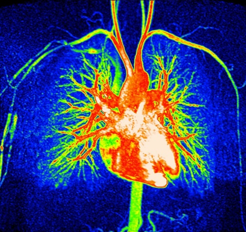 磁気共鳴血管撮影法（MRA）によって映し出された心臓周辺の複雑な血管ネットワーク。植物性食品中心の食生活は、血圧を下げ、悪玉コレステロールを減らし、心血管疾患のリスクを下げることで心臓の健康の改善につながることが、研究によって示唆されている。（Photograph by Zephy/Science Photo Library）