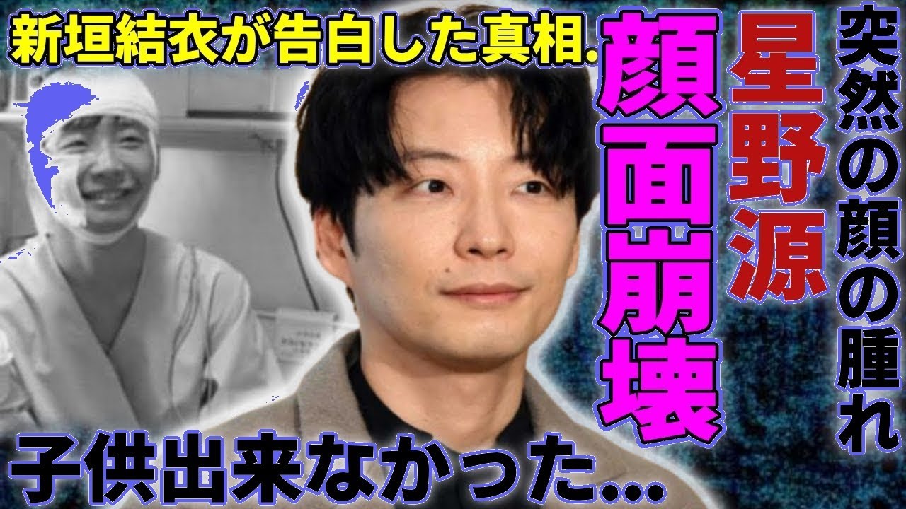 【衝撃】星野源の現在の姿に驚愕…新垣結衣との間に子供ができない意外な理由とは?年収額や顔の腫れの真相も明らかに!