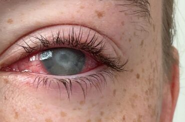 寄生アメーバが引き起こす角膜炎、失明の恐れも　コンタクトレンズ利用者が感染防止のためにすべきこと - CNN.co.jp