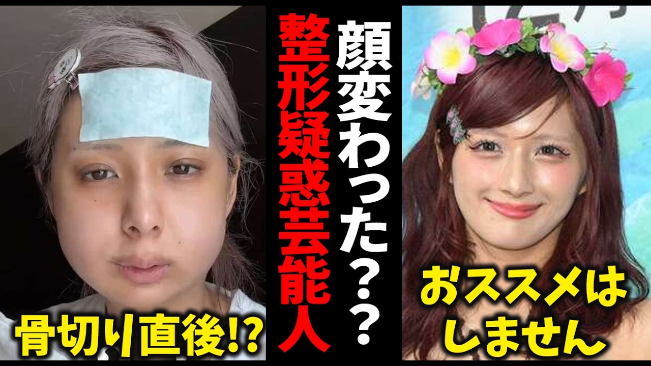 【整形した?】顔が変わってしまった芸能人まとめ【ガルちゃん芸能・有益2ch】