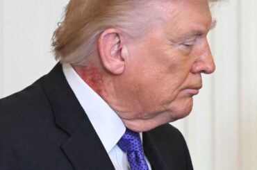 トランプ米大統領の首に発疹、「予防的な皮膚治療」によるものと主治医 - CNN.co.jp